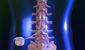 spinal-cord-stim