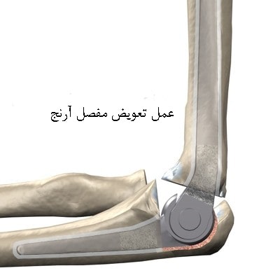 آرتروپلاستی آرنج (تعویض مفصل)