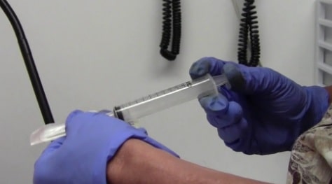 درمان کیست گانگلیون و پارالابرال(چربی روی شانه)