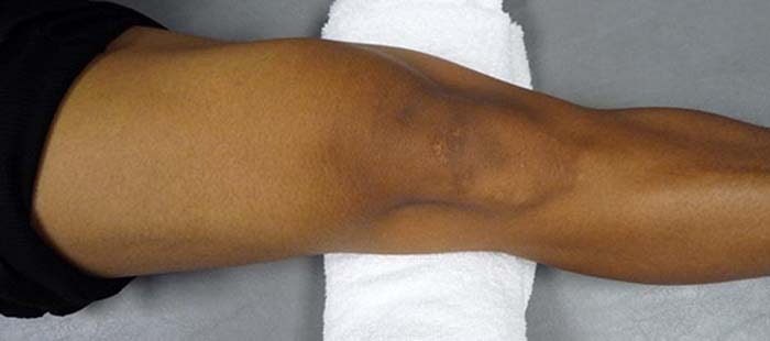 انقباض عضله چهار سر ران 