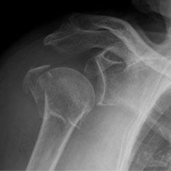 بررسی و آزمایشهای تشخیصی برای شکستگی مفصل شانه