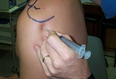 درمان کیست گانگلیون و پارالابرال(چربی روی شانه)