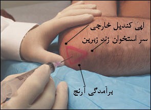 تزریق کورتیزون