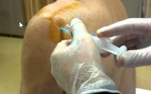 درمان تاندونیت شانه