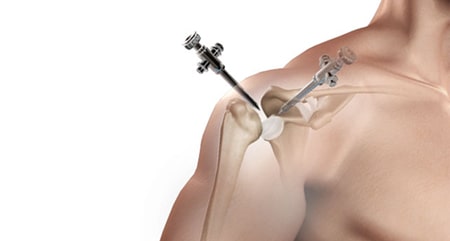 چگونه آرتریت روماتوئید مرتبط با شانه درمان می&zwnj;شود؟