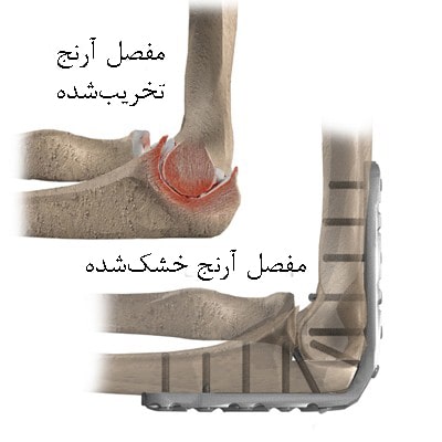خشک&zwnj;کردن مفصل آرنج (فیوژن)