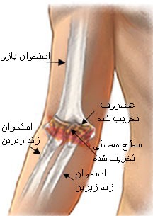 علائم آرتروز آرنج