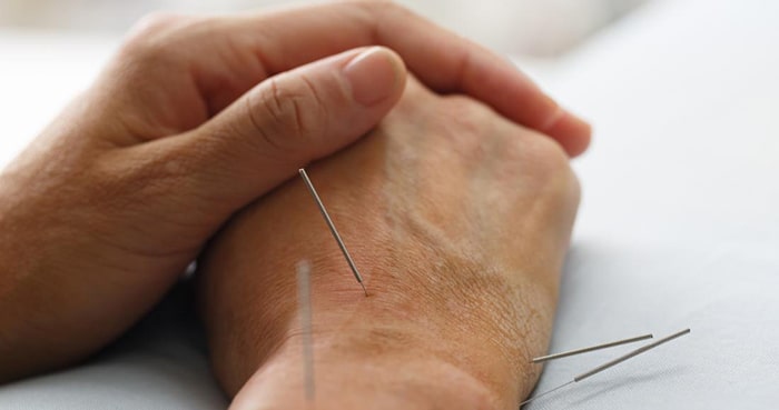 درمان با طب سوزنی چگونه انجام می&zwnj;شود؟
