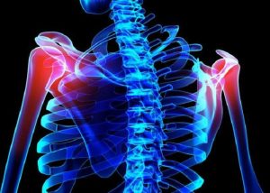 درمان شانه&zwnj;های نابرابر به علت وضعیت نادرست و اختلالات عضلانی شانه