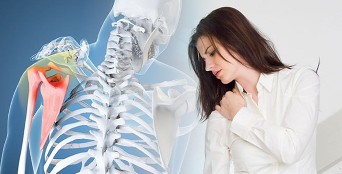 درمان صدا دادن مفصل شانه (استخوان کتف اسکاپولا) با فیزیوتراپی-