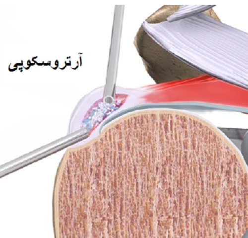 درمان تاندونیت شانه