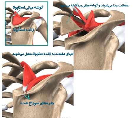 رزکشن استخوانی