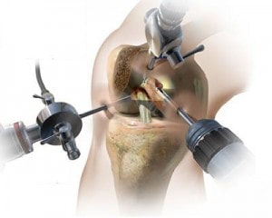 سینووکتومی و برداشتن خارهای استخوانی