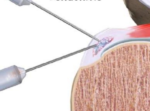 درمان تاندونیت شانه