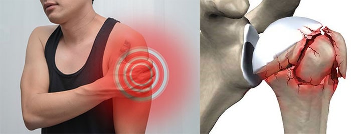 شکستگی استخوان شانه با فیزیوتراپی و جراحی مفصل داخلی و خارجی ترقوه