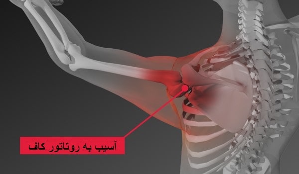 پارگی روتاتور کاف شانه(عدم اتصال تاندونهای چهار عضله)بایا بدون جراحی