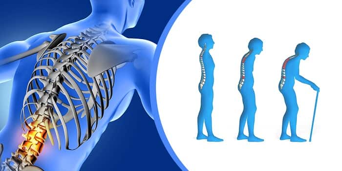 کوتاه شدن قد یا گوژپشتییکی از علائم پوکی استخوان