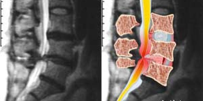 علل تنگی کانال نخاع , تنگی کانال نخاع