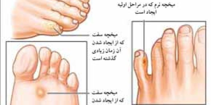 میخچه کف پا