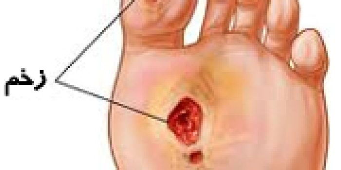 بیماری دیابت