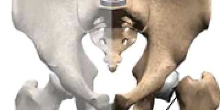 علل شکستگی لگن