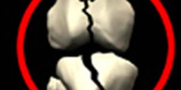 شکستگی استخوان