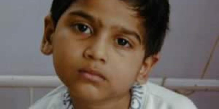 تورتیکولی یا کجی گردن