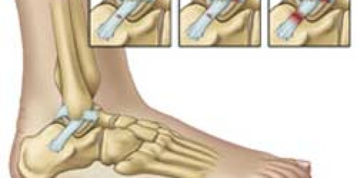 کشیدگی تاندون یا رباط مچ پا, پیچ خوردگی مچ پا