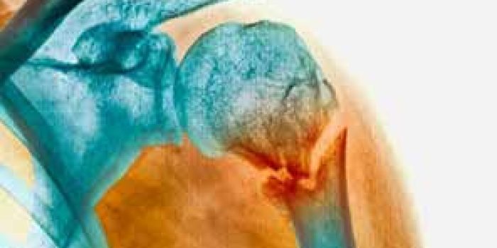 خشکی مفاصل, خشکی مفصل در صبح, درمان خشکی مفصل