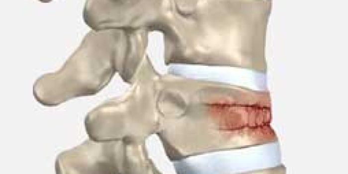 شکستگی گردن