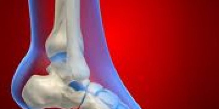 افتادگی مچ پا