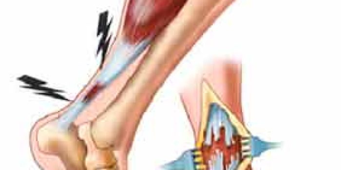 تاندون آشیل