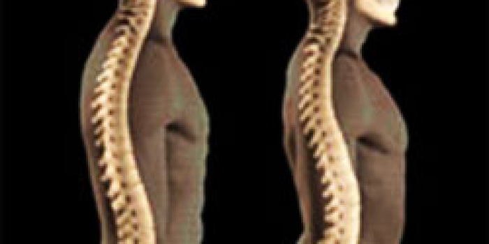 پیشگیری از گودی بیش از حد کمر, گودی کمر,کمردرد,درمان کمردرد