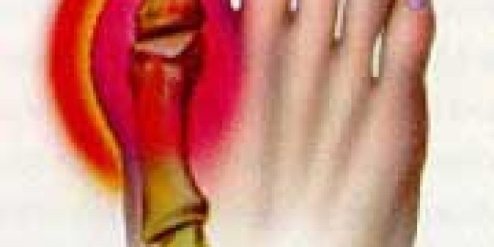 نقرس,علائم نقرس,عوارض نقرس,ورم مفاصل,درمان نقرس