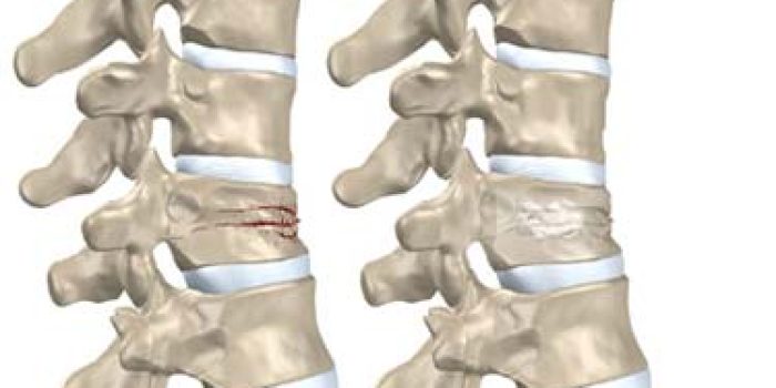 شکستگی ستون فقرات , علائم شکستگی ستون فقرات