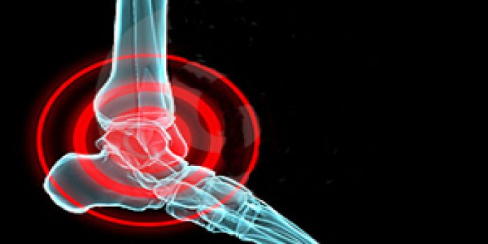 درد مفاصل , درمان درد مفاصل