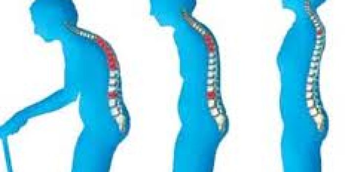 پوکی استخوان و افراد مسن