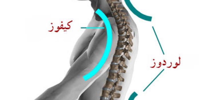 گودی کمر , درمان گودی کمر, افزایش بیش از حد گودی کمر