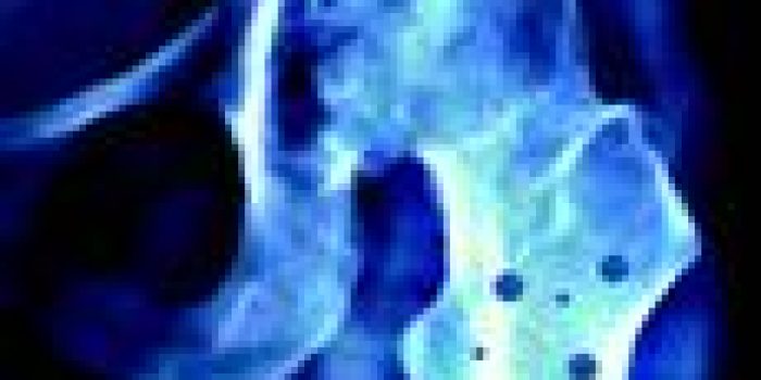 آرتروز زانو,ساییدگی مفصل,زانو درد,علائم زانو درد,درمان آرتروز زانو