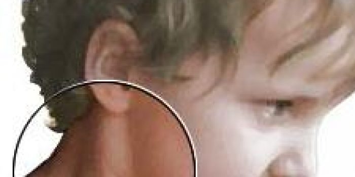 5a9b73af16e998c9c376e619bcd69a7etorticollis