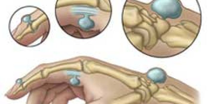 گانگلیون, درمان گانگلیون, عوارض گانگلیون