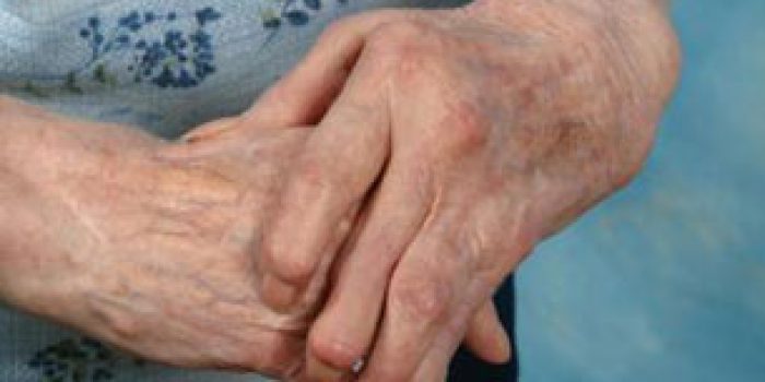 نرمی مفاصل, درمان نرمی مفاصل, سندرم شلي بيش از حد مفاصل