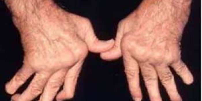 روماتیسم مفصلی,علائم روماتیسم مفصلی,آرتریت روماتوئید,تخریب غضروف