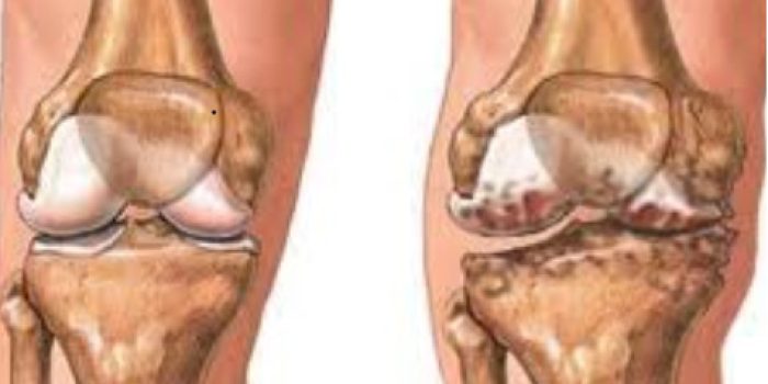 Knee-1