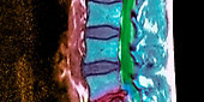 M3301586-Slipped_disc,_MRI