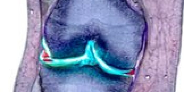 آرتروز زانو, زانو درد , پیشگیری از زانو درد