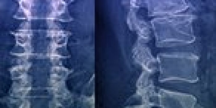 M7280054-Laminectomy_for_spinal_stenosis,_X-ray