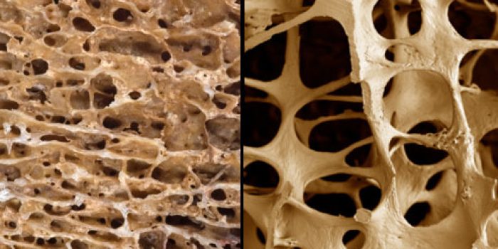 Osteoporosis-Web-MD1
