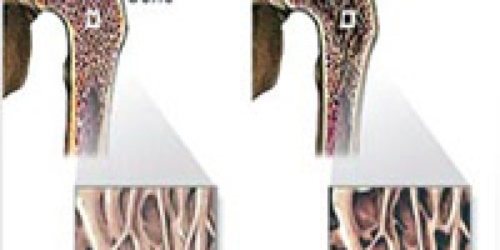 Osteoporosis