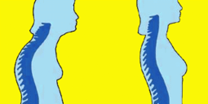 ScheuermannsKyphosis